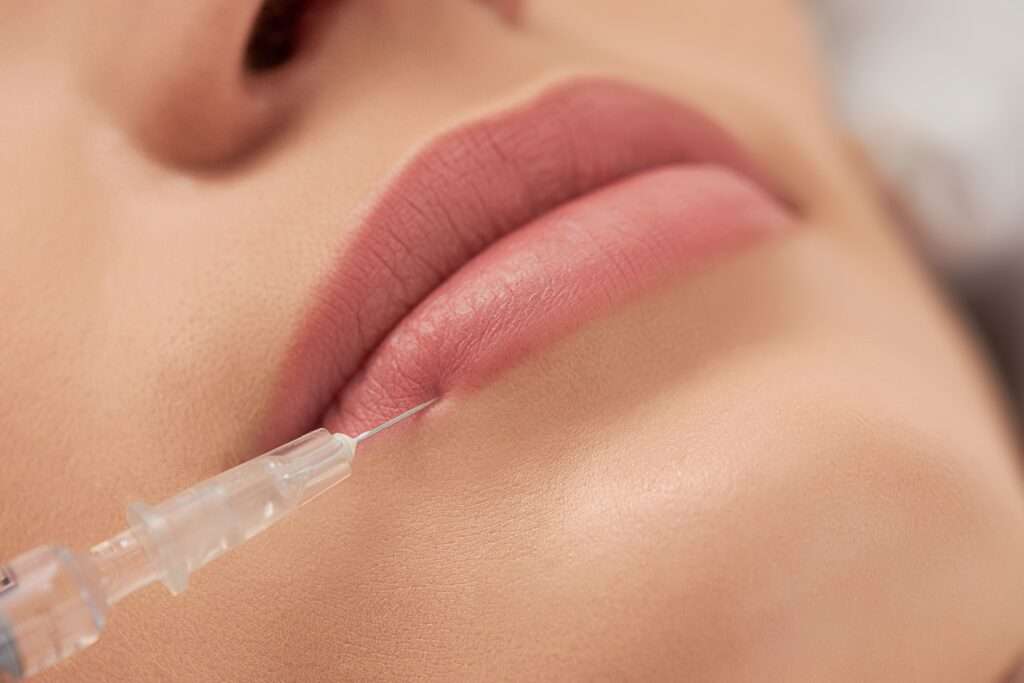 procedure-lip-augmentation