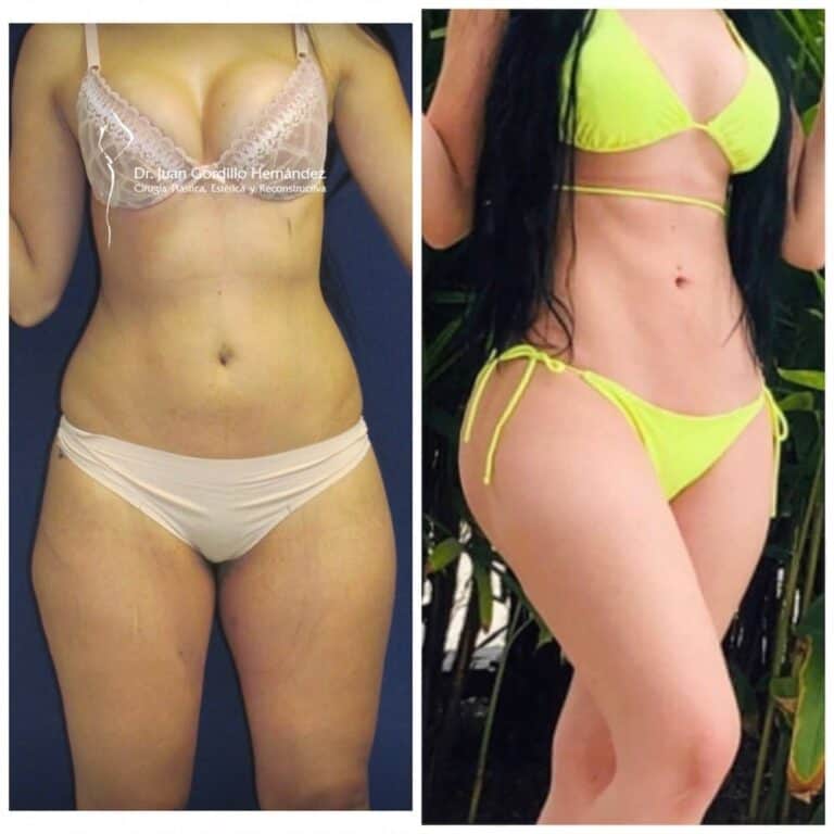 lipoescultura en guadalajara con aumento de gluteos dr juan gordillo cirujano certificado
