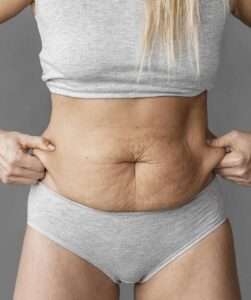 abdominoplastia en Guadalajara, Dr Juan Gordillo - Dr. Juan Gordillo abdominoplastia en Guadalajara, Dr Juan Gordillo