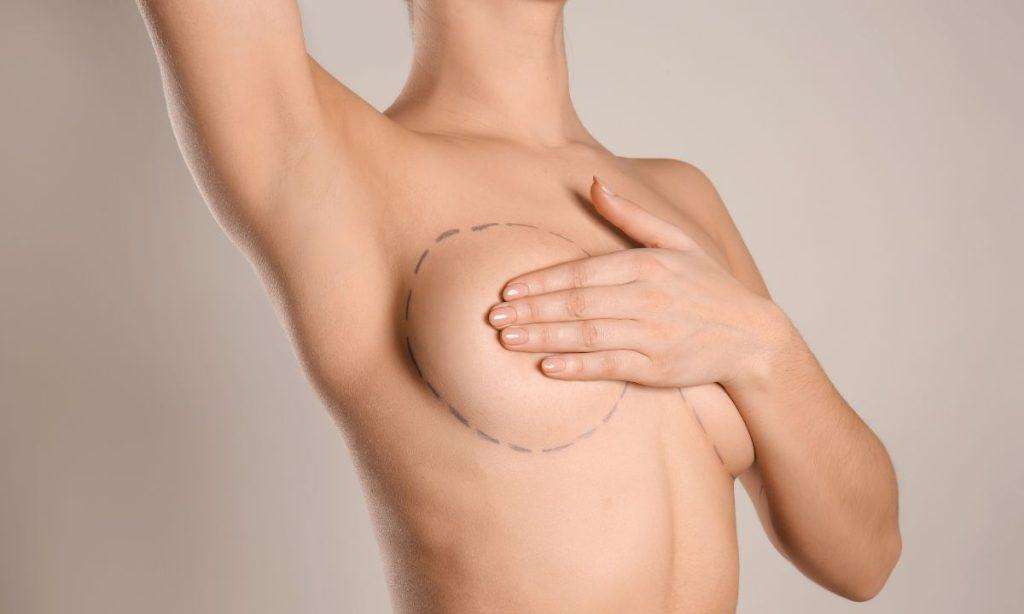 Levantamiento-de-senos-guadalajara - Dr. Juan Gordillo Aumento de Busto en Guadalajara, Dr Juan Gordillo