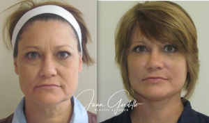 FACELIFT in Mexico, Dr Juan Gordillo
