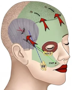 Lifting facial y de cejas endoscópico en Guadalajara