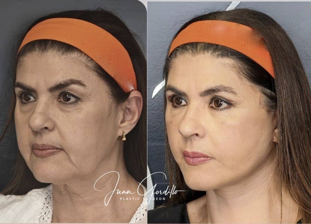 rejuvenecimiento facial con cirugia, lifting facial en guadalajara